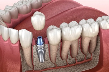 dental implant integrating with the jawbone