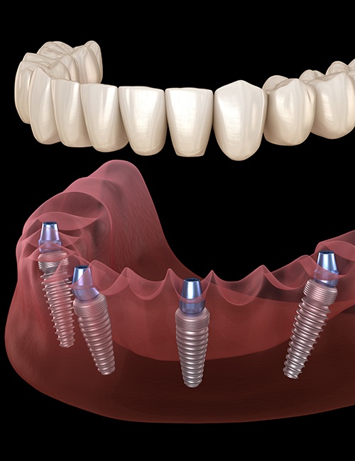 Illustration of dentures being attached to All-on-4 dental implants